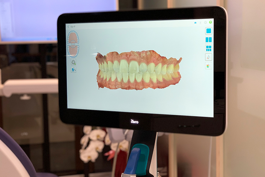 光学スキャナー（ITERO）を用いた型取りとシミュレーション